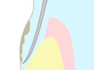 フラップ手術