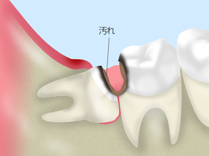 親知らずを抜歯したほうがいい場合