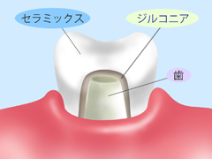ジルコニア（自費診療）